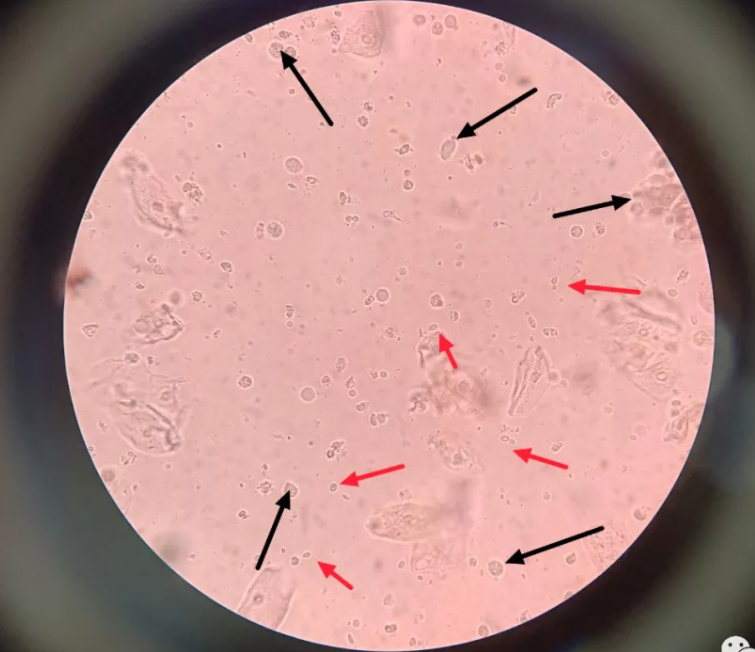 婦科感染中的極特殊情況了解下！