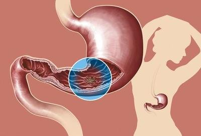 做好這些|慢性萎縮性胃炎離胃癌就會更遠(yuǎn)！